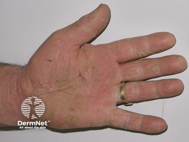 Gambar 2: Hyperkeratosis eksim. Credit: dermnetnz.org